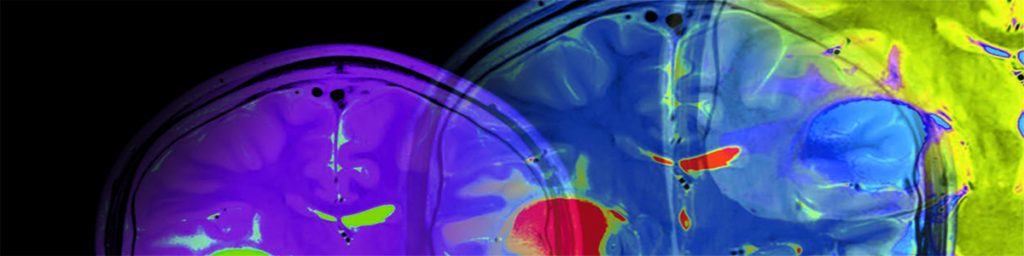 Bättre prognostisering av patienter med traumatisk hjärnskada med nya DT-klassificeringssystem