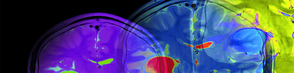 Bättre prognostisering av patienter med traumatisk hjärnskada med nya DT-klassificeringssystem