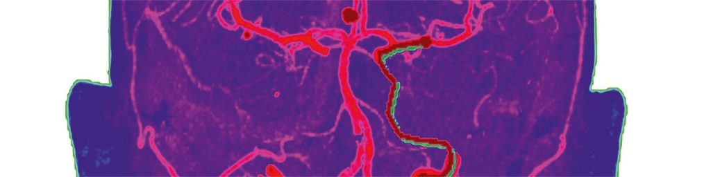 Ett automatiskt verktyg för analys av blodflödet i hjärnan