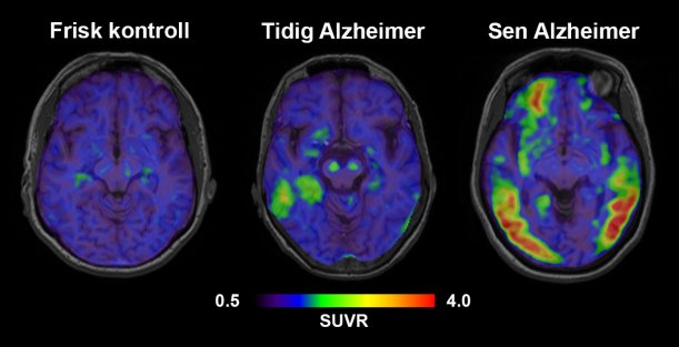 Ny hjärnstudie ger bild av alzheimer långt före utvecklad sjukdom