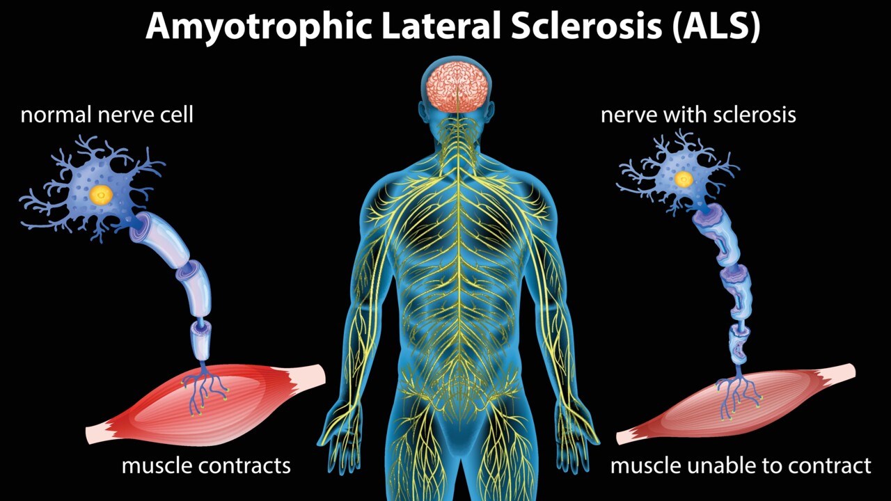 Immunterapi ger hopp om behandling som bromsar ALS