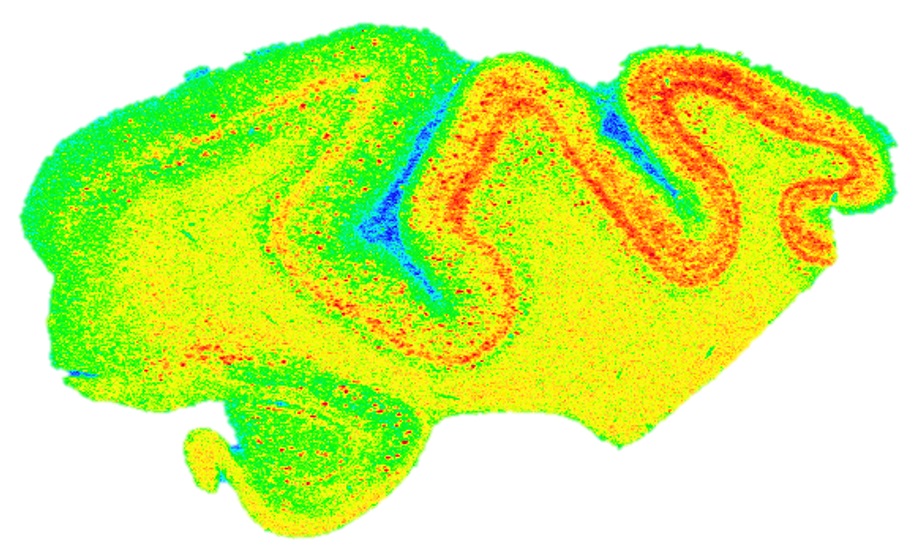 Tidiga tecken på alzheimer hos personer med Downs syndrom