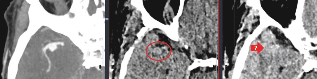 Neuroradiologisk A-B och C-D-lära – Del 4. M – P