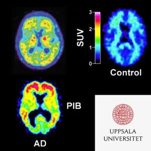 PODDTIPS: Ny behandling mot Alzheimers