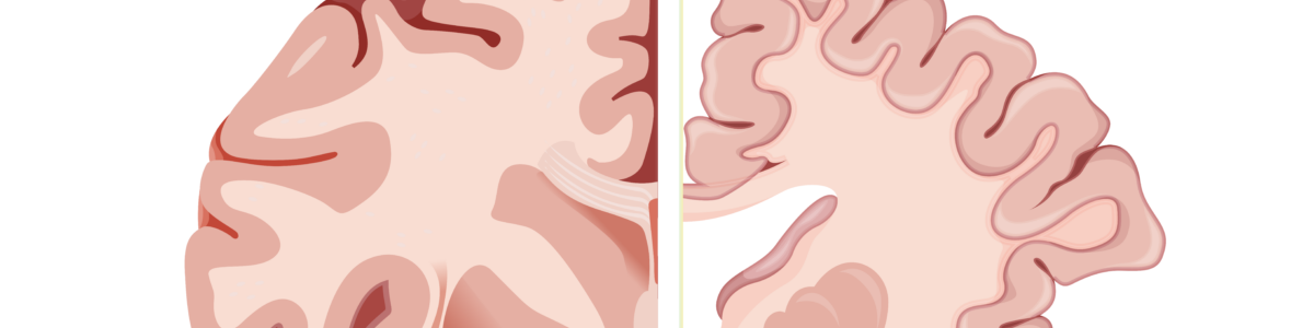 Från biomarkörer till behandling – nya rön inom neurodegenerativ sjukdom