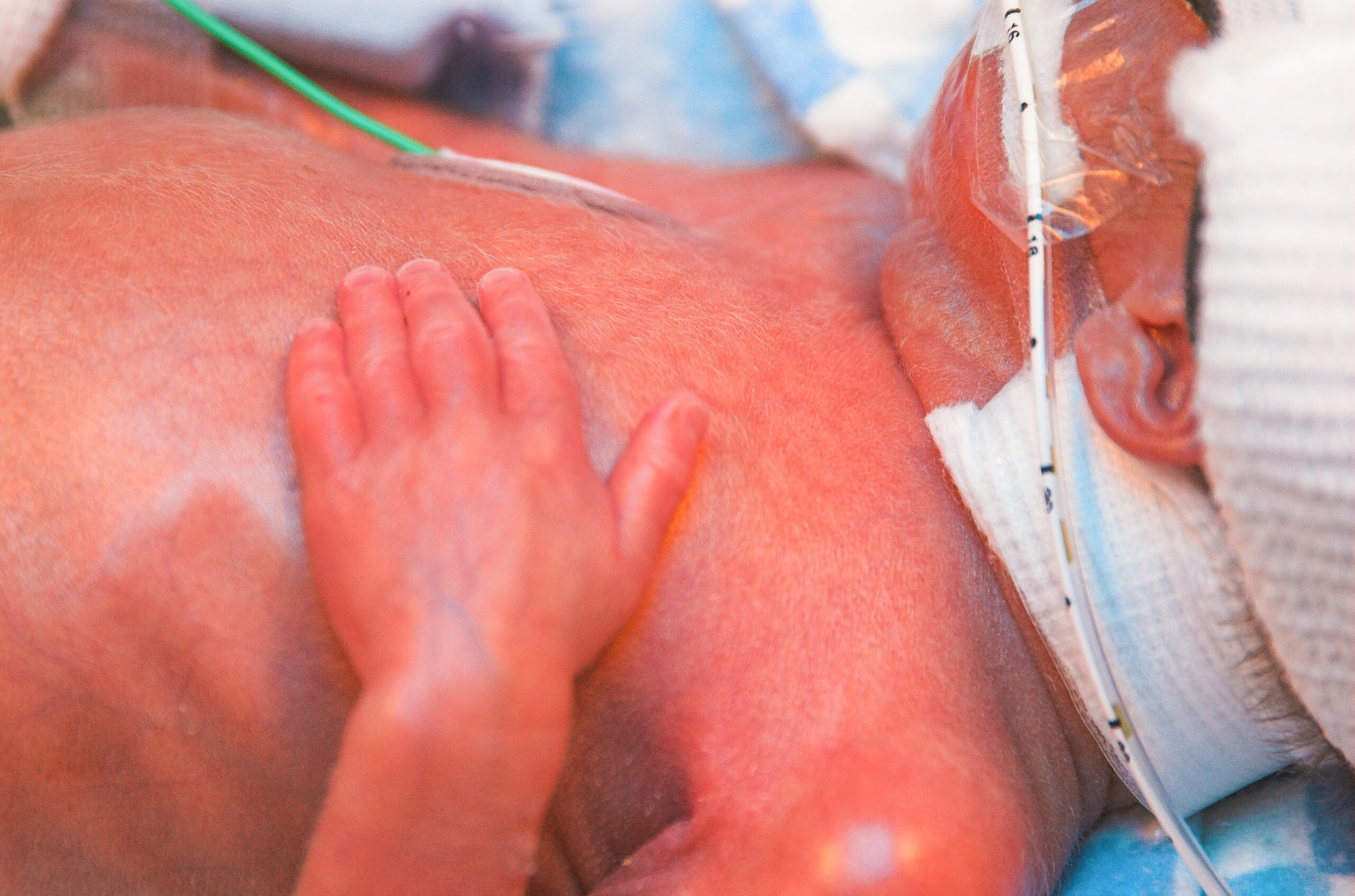 Potential för antiinflammatorisk behandling vid neonatal blödning